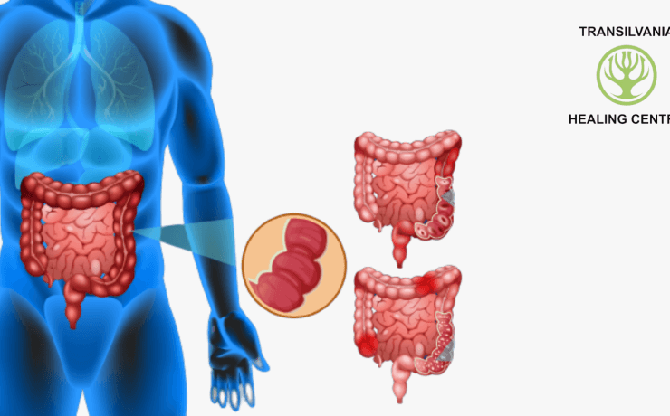 Remediază Vizualizați soluții pentru colonul iritabil - Imagini și ilustrații relevante